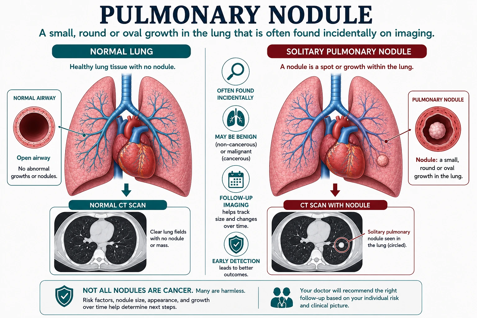 Medical illustration of a solitary pulmonary nodule in the lung with corresponding chest CT appearance, contrasted with normal lung imaging.